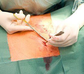 Abdominal Hysterectomy Surgery