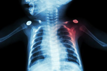 x-ray of brachial plexus palsy