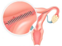 Essure placement