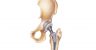 Hip Replacement Illustration