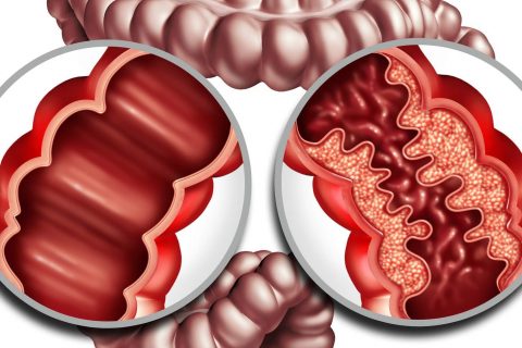 Crohn's Disease