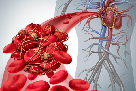 illustration of blood clot