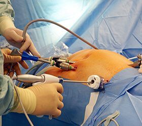 Laparoscopic Hysterectomy Surgery