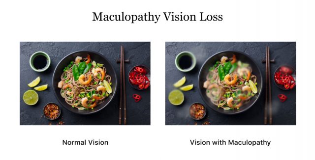 Vision loss from maculopathy