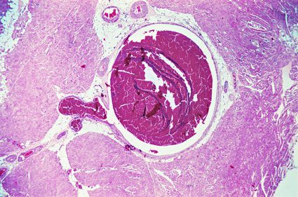 Deep Vein Thrombosis Micrograph