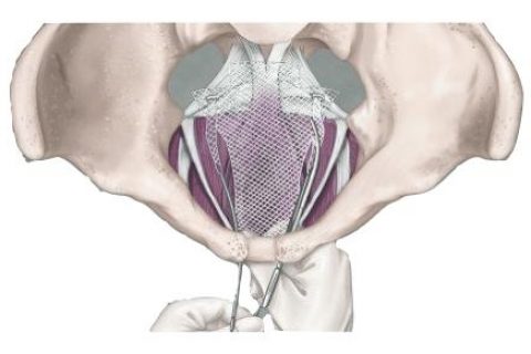 Illustration of Transvaginal Mesh procedure