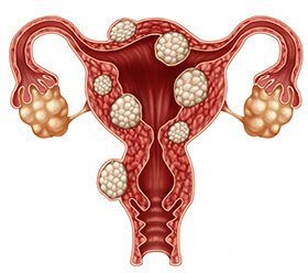 Uterine Fibroids